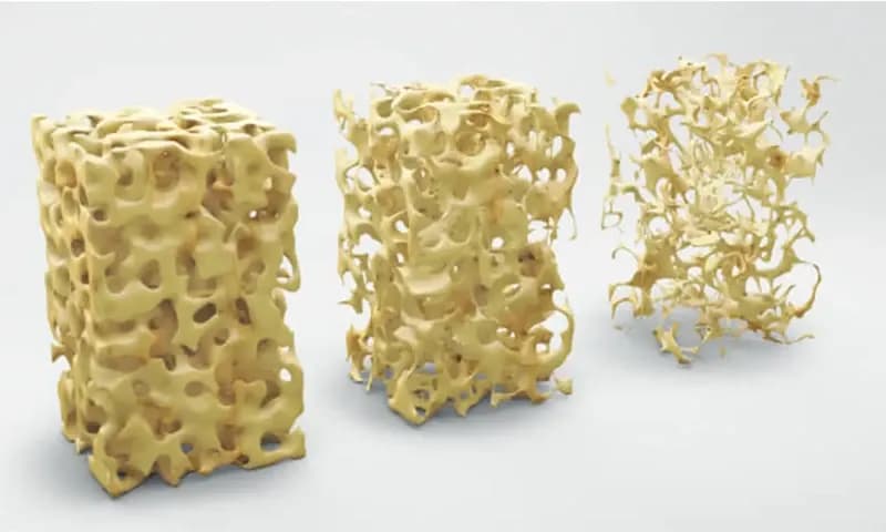 cara mencegah osteoporosis (dok. istockphoto.com)