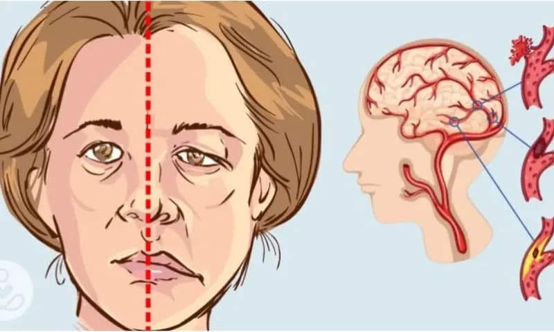 Gejala Stroke (dok. rri.co.id)