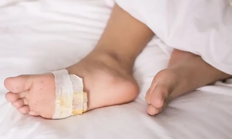 Kenali Ciri-ciri Luka Diabetes dan Cara Merawatnya (Foto: Kompas Health)