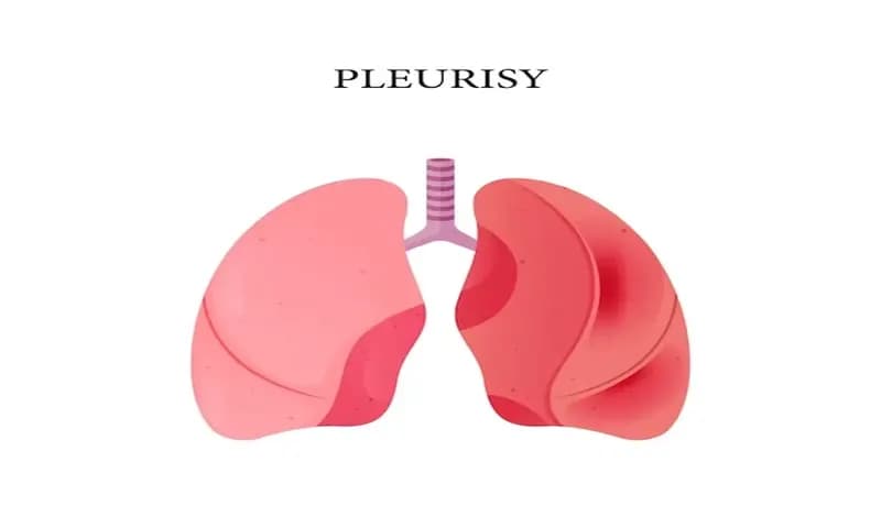 Ilustrasi Penyakit Pleuritis (Foto: Freepik)