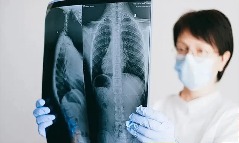 Hasil rontgen yang memperlihatkan kanker paru-paru pada tubuh manusia (Foto: siloamhospitals.com)