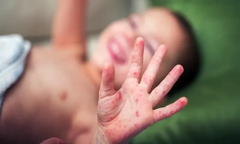 Cara Mencegah Flu Tomat (Foto: shutterstock.com)
