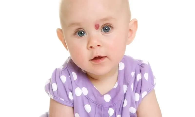 Hemangioma (Foto: Shutterstock)