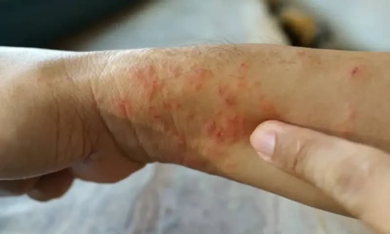 Kulit yang terkena penyakit eksim, menimbulkan gejala ruam kemerahan. (Foto: iStock/ Tylim)
