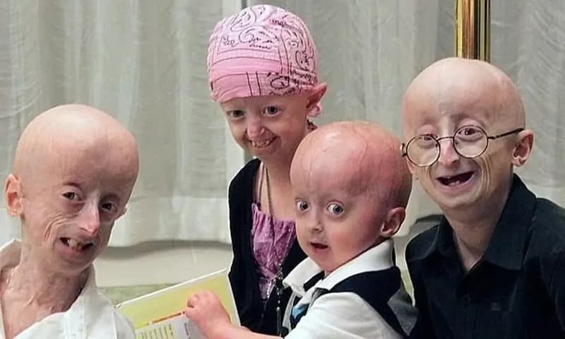 Pengidap Penyakit Terlangka di Dunia Progeria (Foto:25hournews.com)