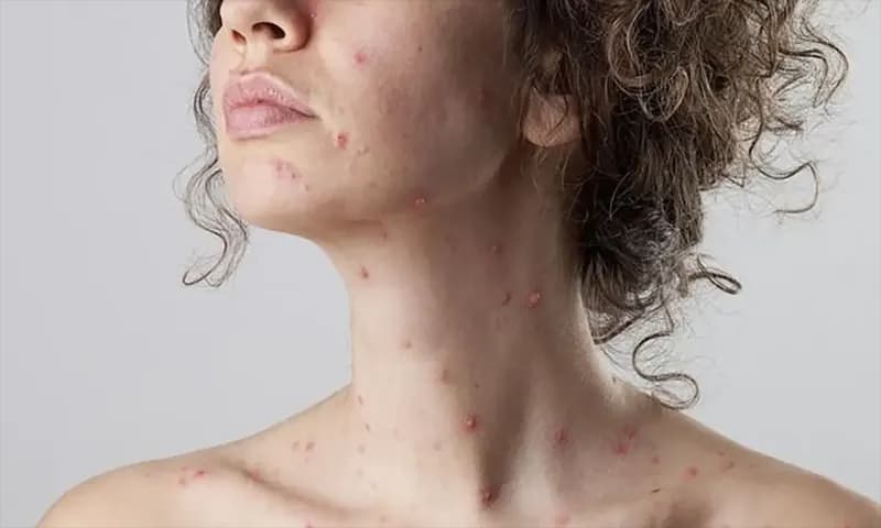 Ilustrasi. Seorang wanita terkena cacar air (Foto: iStock/CactuSoup)