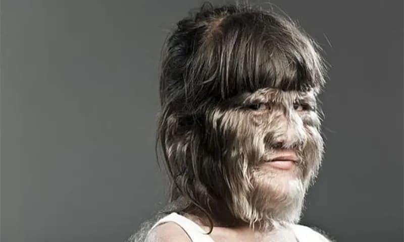 Sindrom manusia serigala atau werewolf syndrome (livescience.com)