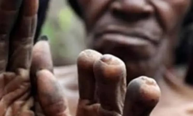 Potong Jari merupakan salah satu contoh tradisi yang dilakukan beberapa suku di Papua (Foto: Instagram/@tradisi_papua)