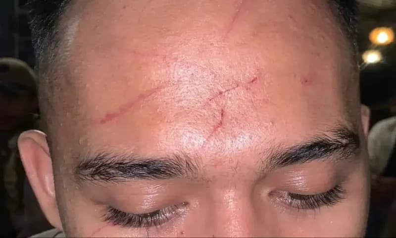 Salah satu mahasiswa yang terluka saat aksi menuntut kebebasan berpendapat di Universitas Sarjanawiyata Tamansiswa Yogyakarta. (Foto: Instagram/ @socialmovementinstitute)