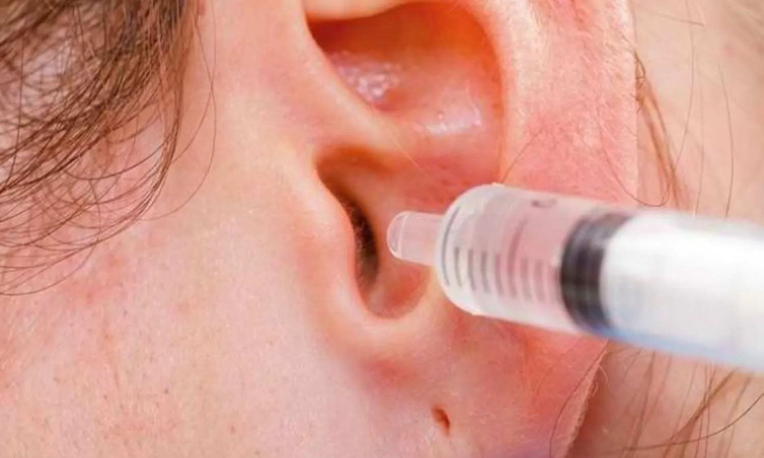 Прочистить пробки в ушах в домашних условиях. Промывание ушей перекисью водорода. Промывание ушей от серных пробок.