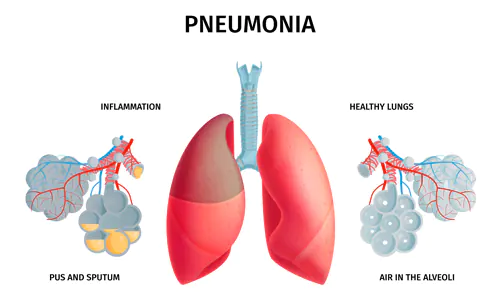 pneumonia