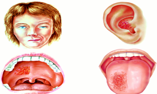 ramsay hunt syndrome